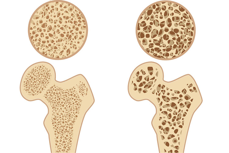 骨粗鬆症イメージ
